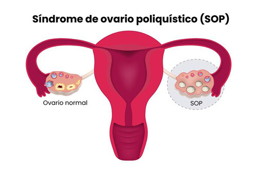 nutriologos especialistas en ovario poliquistico en mexicali